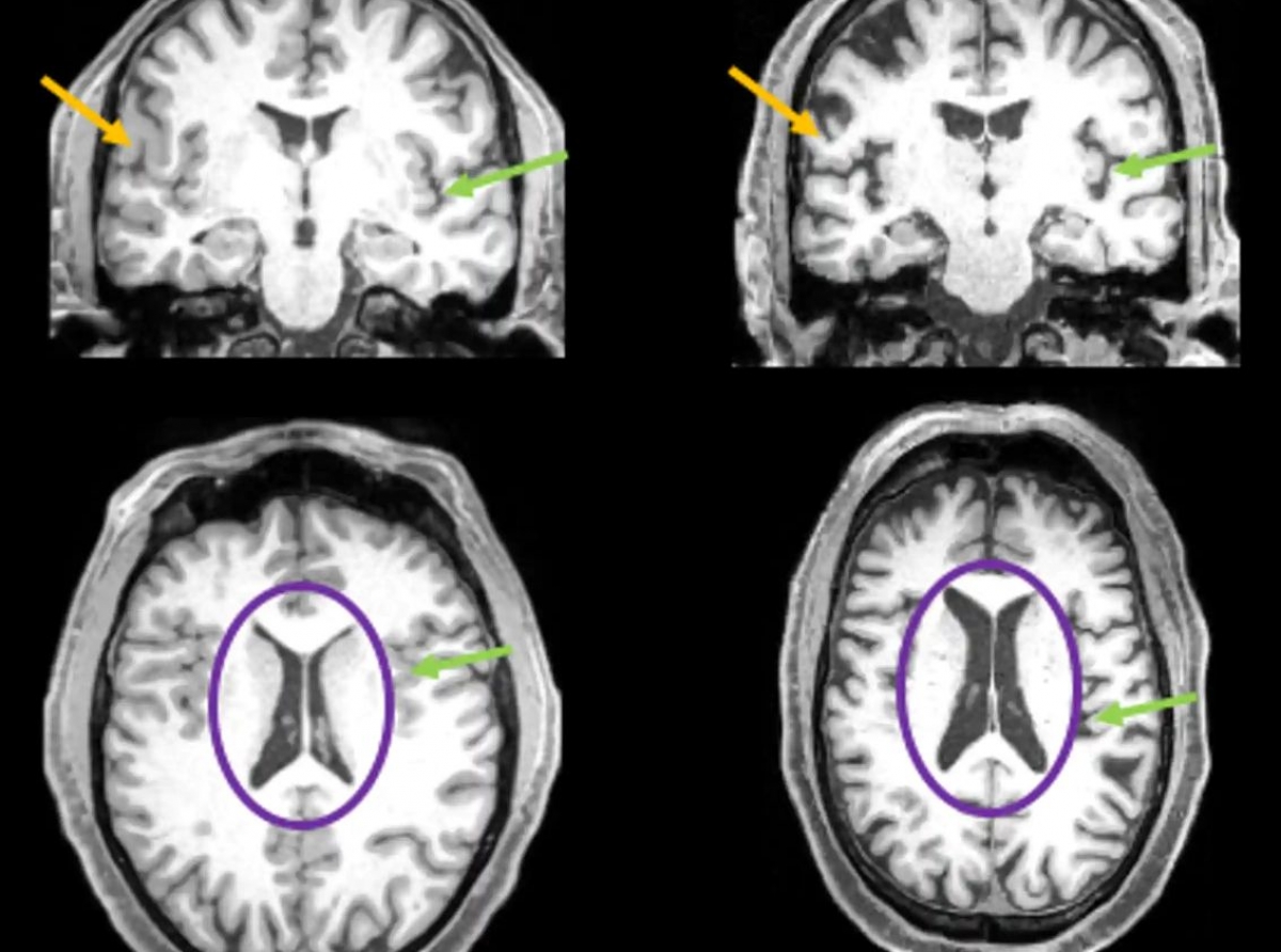 Neuroimágenes antes y después de covid