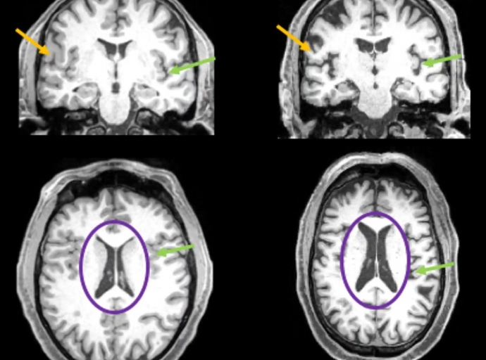 Neuroimágenes antes y después de covid