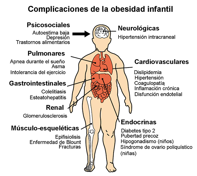 obesidad infantil